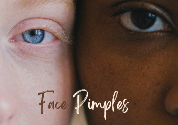 Pimples
